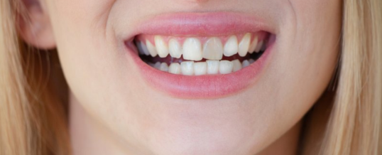 Should I get Teeth Whitening Before Crowns?