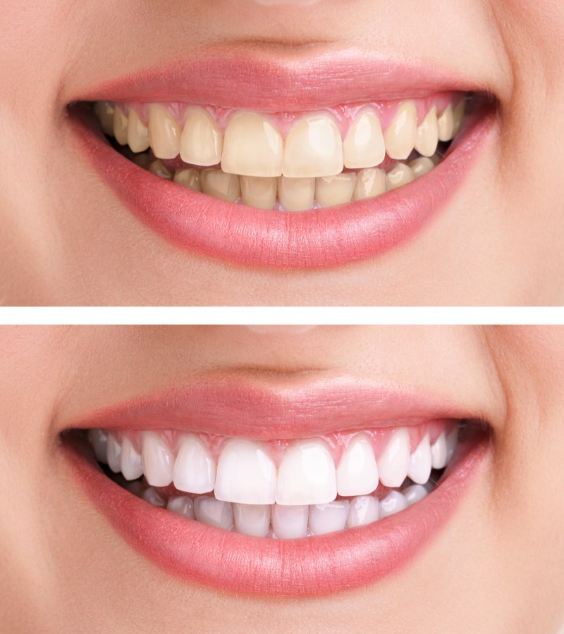 Teeth Stain Removal